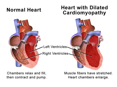 lv dilatation definition|dilated cardiomyopathy signs and symptoms.